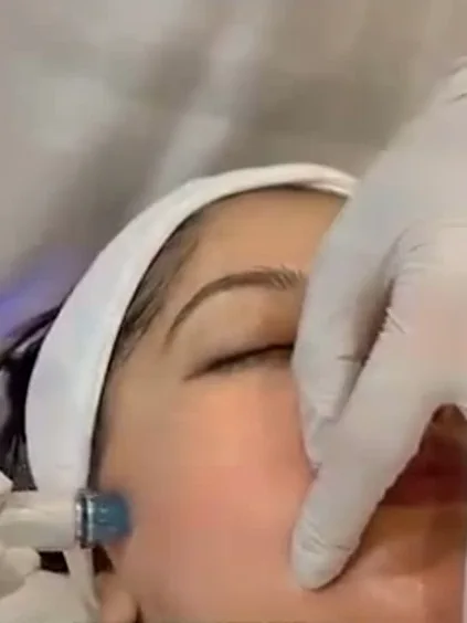 A HydraFacial in progress, gloved hands and a headband.