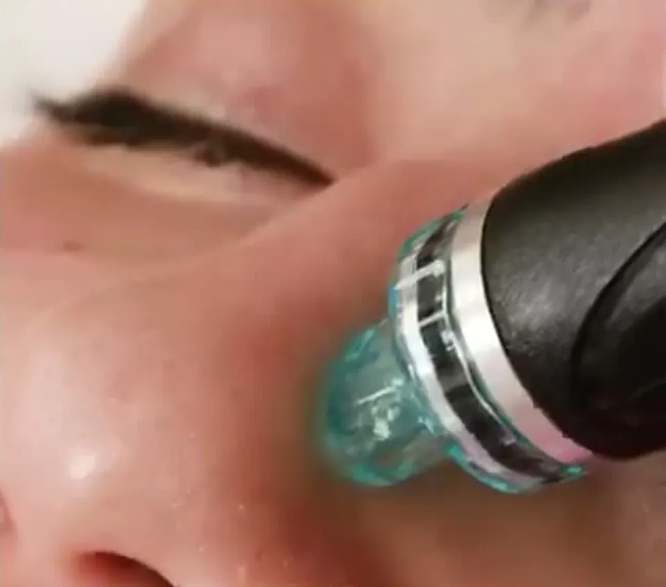 A HydraFacial handpiece moving across a cheek.